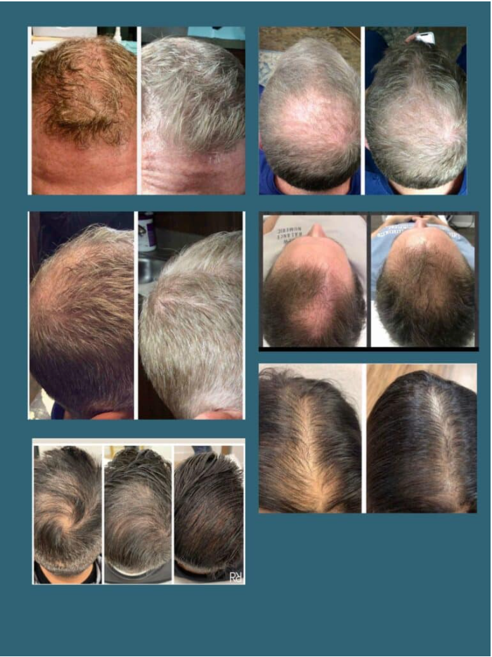 BLACK FRIDAY SPECIAL - KeraLase Hair Restoration: Buy 4 Treatments, Get 2 FREE $3000 (reg. $4500)