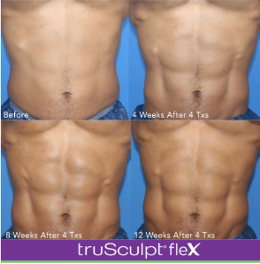 DEALS THAT SLEIGH - $699 TruSculpt Muscle Toning Package (reg. $999)